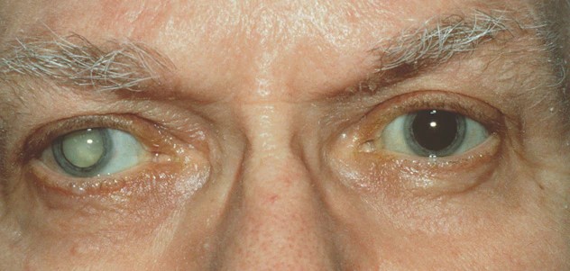 ds00050_im01228_vi7_cataractthu_jpg.jpg